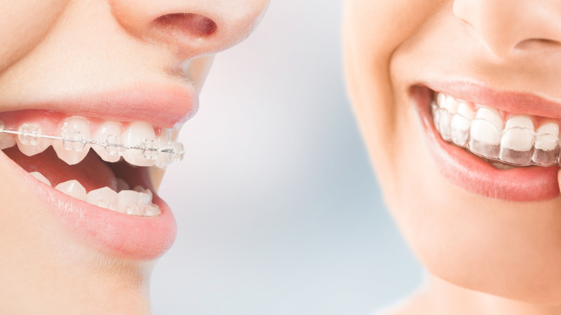 Braces vs Aligners: You Have Choices!