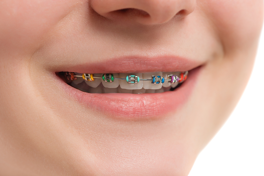 Transform Your Smile: A Complete Guide to Braces in Pensacola, FL