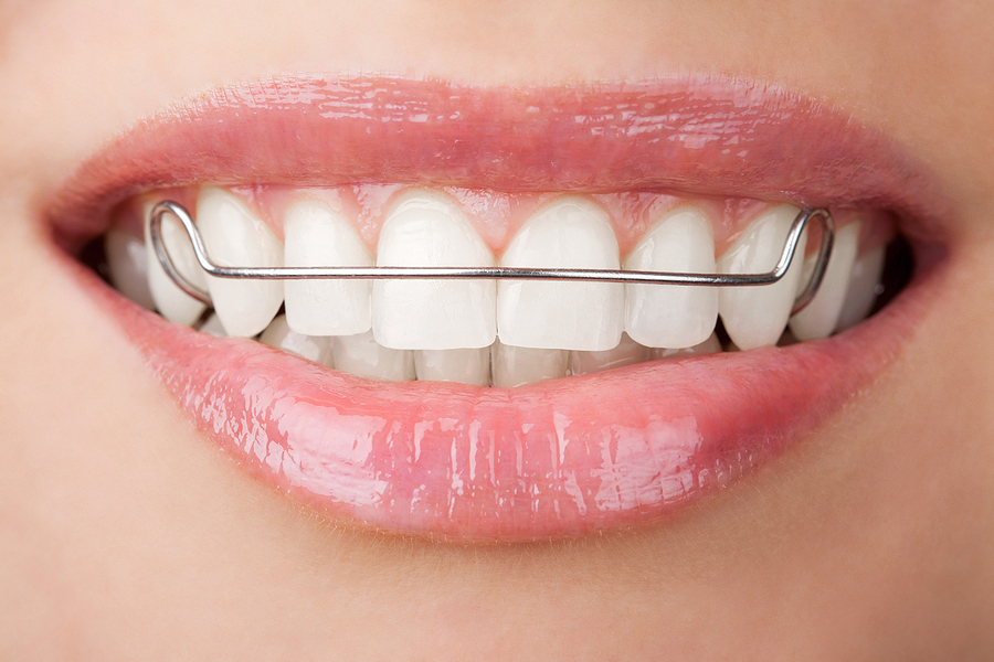 The Importance of Retainers for a Lasting Smile in Pensacola, FL