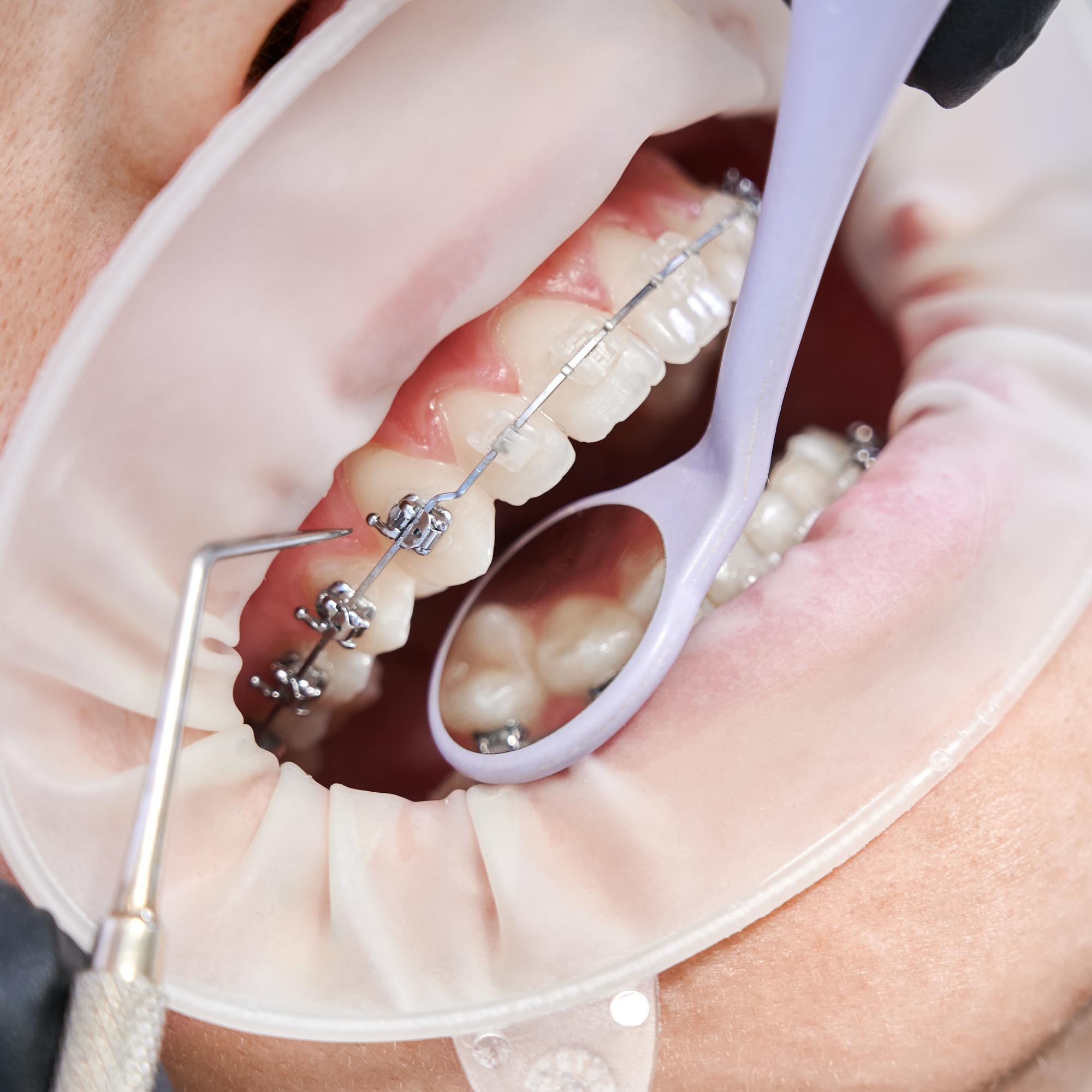 The Importance of Two-Phase Treatment for Orthodontics in Pensacola, FL